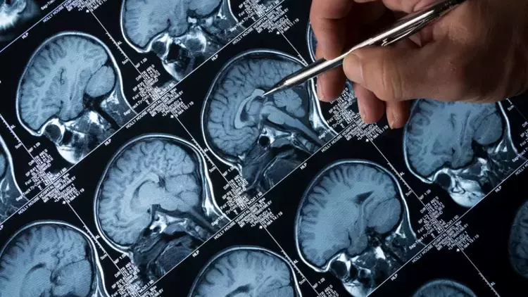 Alzheimer’ı yenmenin yolu gerçekten bulundu mu? Hastalar anlatıyor: Ölümcül hastalığın etkilerini tersine çevirdik! hurriyet.com.tr/aile/alzheimer…
