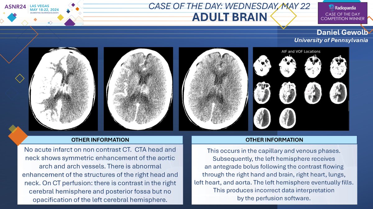 #ASNR24 #COTD: Wednesday Brain Thx to Dr. Daniel Gewolb @daniel_gewolb #Radiopaedia Case of the Day Winner! NO SPOILERS!!! Give answers as GIFs ONLY. Submit answers for a chance to win prizes! Answer tomorrow morning. #ASNR24 #Neuroradiology #FOAMed #RadRes #MedEd