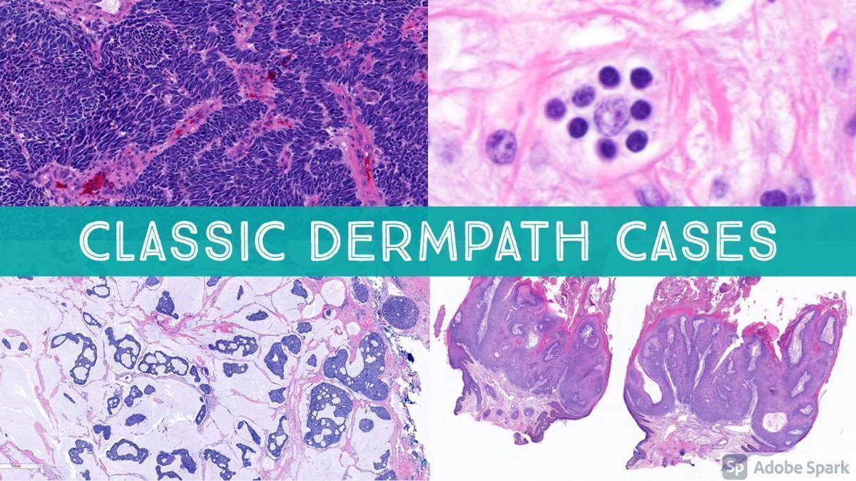 10 Classic Dermatopathology Cases from the Head & Neck. Video: kikoxp.com/posts/6045. Enjoy! #pathology #pathologists #pathTwitter #dermpath #dermatology #dermatologia #dermtwitter #ENTpath #oralpath