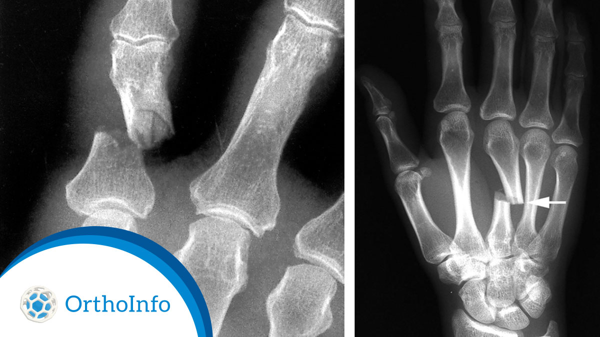 AAOS1's tweet image. @Knicks star Jalen Brunson didn’t think his hand was seriously injured after hard contact in Q3 of Game 7. Turns out it was broken. Learn the symptoms of #handfractures and how they’re diagnosed at #OrthoInfo: bit.ly/3KWt3zV @HandSociety @aossm1972 @NBA #Orthotwitter
