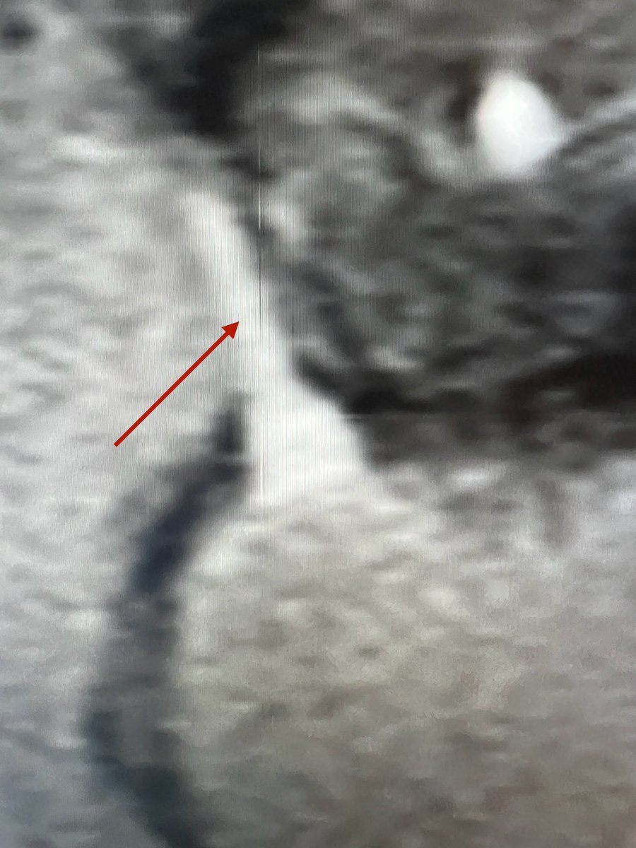 Dr Kish Mankad (@drmankad) on Twitter photo Tip of the day ๐ก: Thickening and enhancement of the 3rd cranial nerve is a feature of ophthalmoplegic migraine. Ensure there is no restricted diffusion here or growth as such in time to exclude the ATRT differential, Tip of the day ๐ก: Thickening and enhancement of the 3rd cranial nerve is a feature of ophthalmoplegic migraine. Ensure there is no restricted diffusion here or growth as such in time to exclude the ATRT differential,