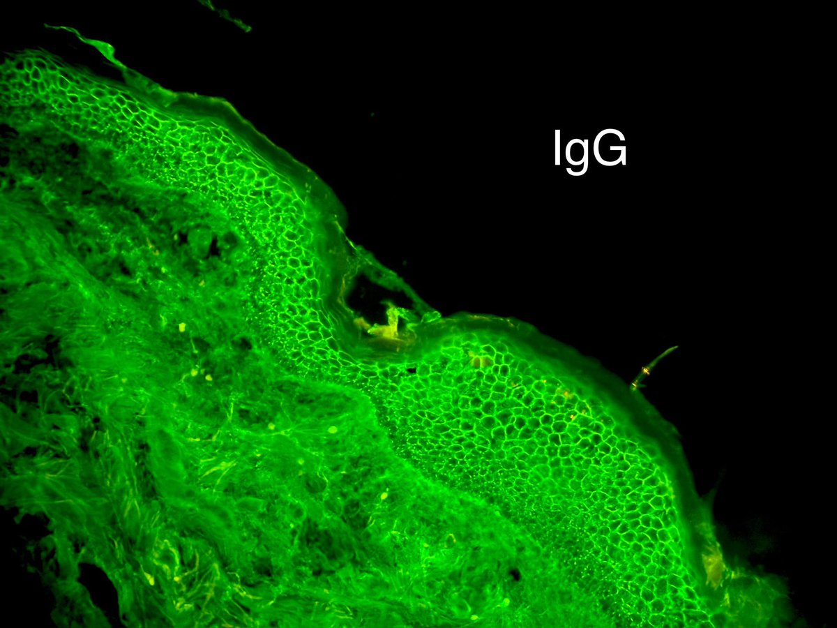 Today’s case for #DermPath learning 
A subtle case of early #PemphigusFoliaceus 
🎓Antibodies to Desmoglein 1 (found mainly in the upper layers of the epidermis)
📸 1 Subtle subgranular layer acantholysis
📸 2 Pericellular IgG
🤓
#pathology 
#dermatology