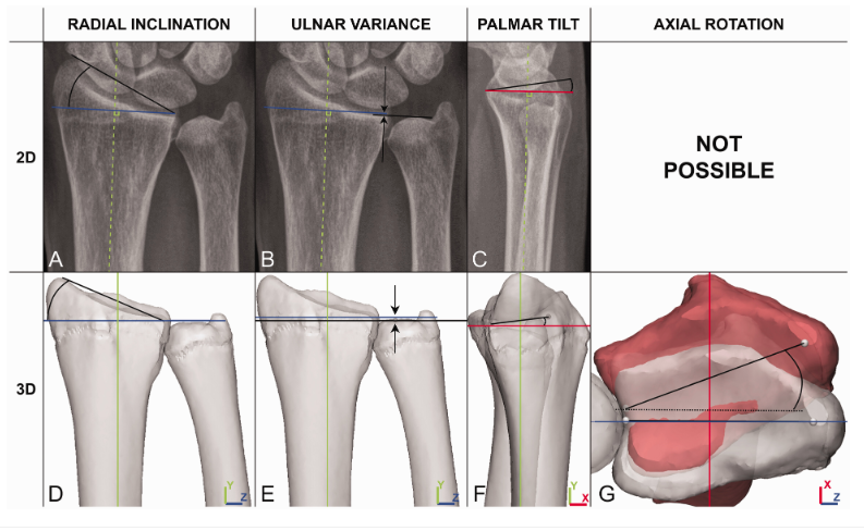 Should we assess malunion of extra-articular distal radius fractures using 3-D CT scans or just 2-D plain radiographs?📸🔍 

#OrthoTwitter #Handsurgery #Radiology #PlasticSurgery #Orthopaedics @Radiopedia
