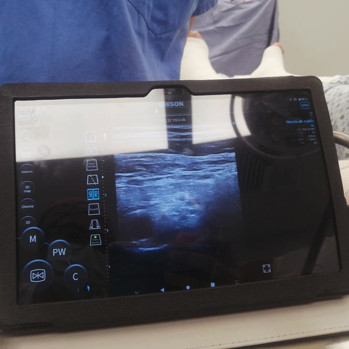 De la práctica ➡️ a la aplicación. #Residentes #R1 #Anestesiologia explorando y realizando bloqueos regionales ecoguiados apoyados con #SonoEye #CHISON #HGT 
<a href="/sonoeye/">Sonoeye Chison México</a> <a href="/chisonmedical/">CHISON</a>