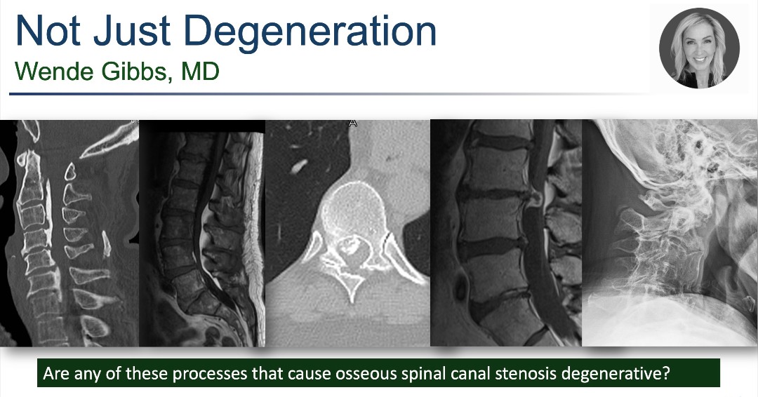 Don't miss Dr. Wende Gibbs at 10:00 am in Augustus VI as she speaks on 'Not Just Degeneration.' Her presentation is part of ASSR-sponsored programming: Case-based Spine Essentials: Practical Tips for All Radiologists. @WendeNGibbs #ASNR24 #Neuroradiology