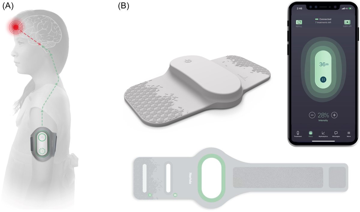 NEW: Acute treatment of #migraine in children aged 6−11: Real‐world analysis of remote electrical #neuromodulation (REN). Read the full #OpenAccess article by Klaus Werner et al.: onlinelibrary.wiley.com/doi/10.1002/cn… @WileyNeuro @HersheyAndrew @DrTrevor1