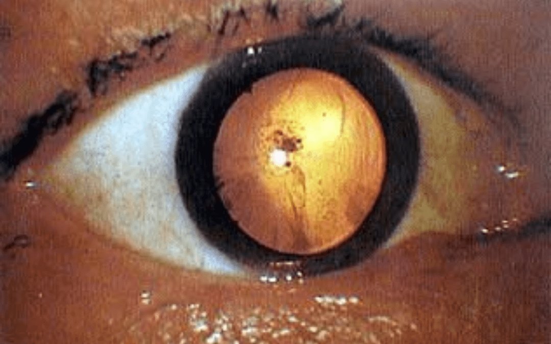 Photograph of a victim's eyeball after bombing of Hiroshima with an atomic bomb cataract, 1945.