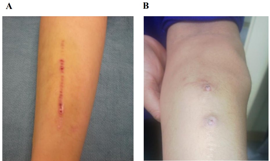 There is a global interest in expanding home dialysis utilization amongst patients with ESKD. This article describes various vascular access options in HHD & what needs to be taken into consideration in the selection and care of this access bit.ly/CJASN0499 @ryanjameschan