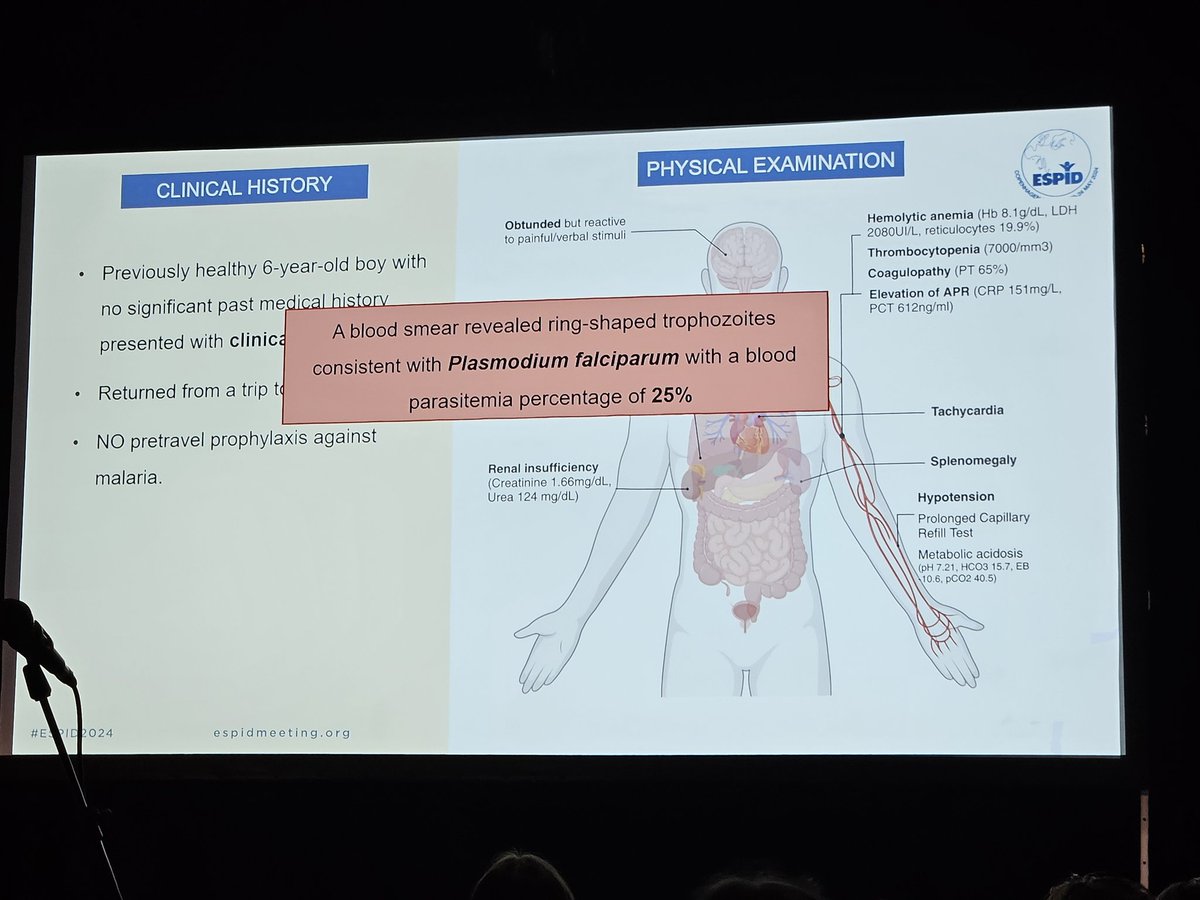 Severe malaria...some interesting cases. #ESPID2024Ambassador #ESPID2024. Meet the Expert - Malaria