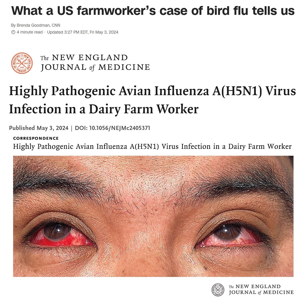'Pink Eye' for the Bird Flu is the new euphemism of the moment, like 'Brain Fog' was and still is for #COVID. 
The first #H5N1 patient had conjunctivitis with subconjunctival hemorrhage in both eyes. According to @CDCgov the same Texas farmworker had only pink eye.