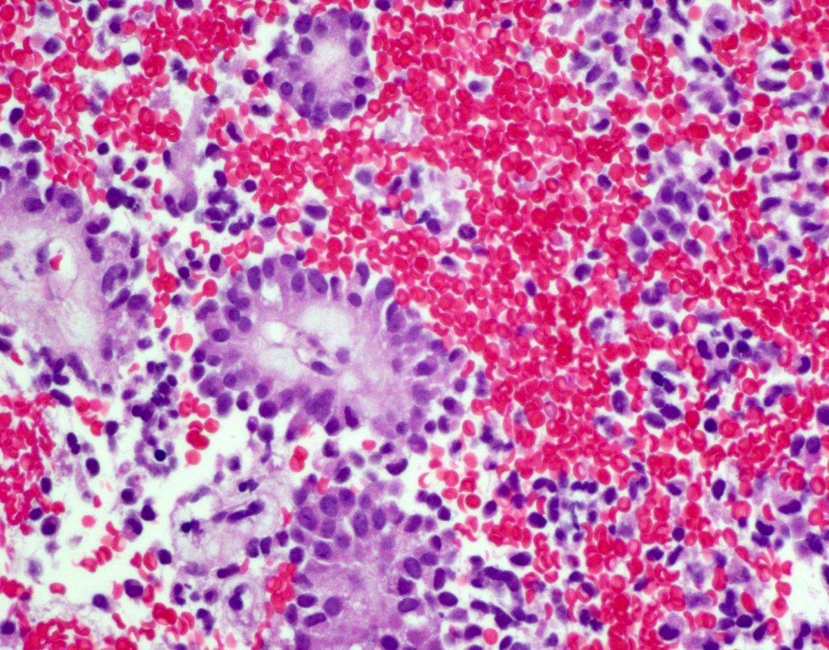 Classical histology and cytology (Pap & CB) of Solid Pseudopapillary Tumor of Pancreas (Frantz tumor) from our friend @dr_emmagonzalez.  Tail of pancreas, BCatenin+, LEF1+, A1AT+ globules, SOX11+. @UMiamiPathology @USGIPS @CancerCytopath @pbpath #pancreastumor