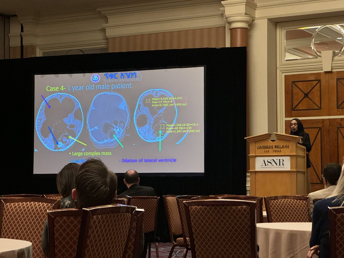 @AmalSalehNour sharing some amazing paediatric cases from Ethiopia at the @The_ASPNR international session #ASNR24 - great to see lots of international collaboration during the meeting!