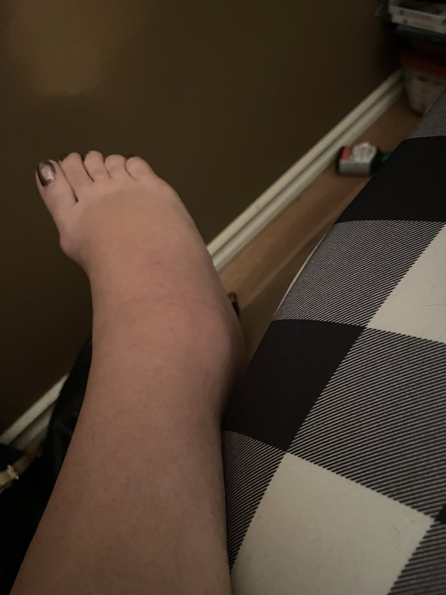 Messed my foot up pretty bad. I’m currently laid up in bed. It’s pretty swollen. Give it a day or two before I go see the doctor.