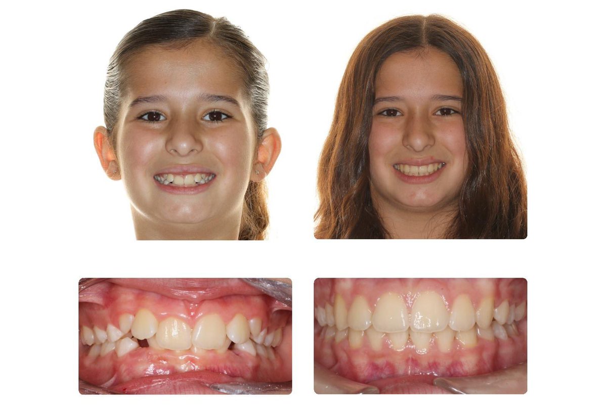 DrGorczyca's tweet image. Deep bite be gone! #deepbite #braces #orthodontics #orthodontist #antiochca