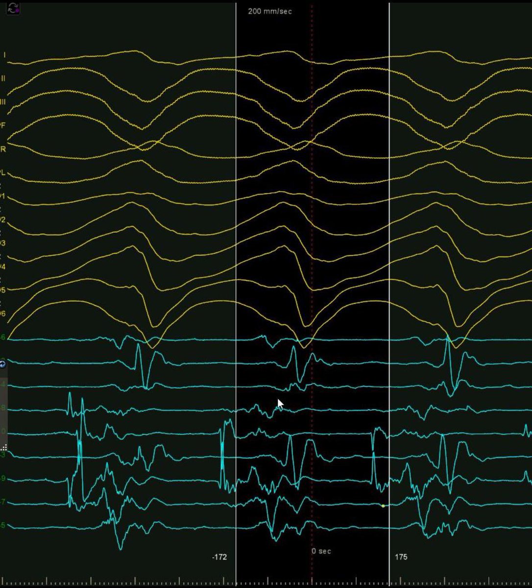 Ben Wiles (@benwilesep) on Twitter photo Epicardial VT ablation: bipolar scar map and a limited activation map (as VT not well tolerated). Excellent signals in VT and ablated to non inducible. Supported throughout by my superb team <a href="/NHSGrampian/">NHS Grampian</a> @BiosenseWebster Epicardial VT ablation: bipolar scar map and a limited activation map (as VT not well tolerated). Excellent signals in VT and ablated to non inducible. Supported throughout by my superb team <a href="/NHSGrampian/">NHS Grampian</a> @BiosenseWebster