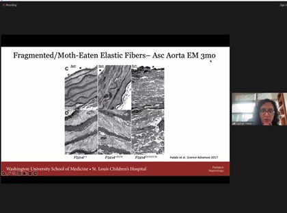 Keia Sanderson, MD MSCR (@drkeia) on Twitter photo And the crowd says “This was one of the best pediatric CVD lectures I’ve heard in a long time!” 🙌🏾🙌🏾 Regarding <a href="/carmen_halabi/">Carmen Halabi</a> giving an incredible <a href="/UNCKidney/">UNC Kidney Center</a> Grand Rounds on “The Vasculature in CKD-Insights From Matrix Models.” And the crowd says “This was one of the best pediatric CVD lectures I’ve heard in a long time!” 🙌🏾🙌🏾 Regarding <a href="/carmen_halabi/">Carmen Halabi</a> giving an incredible <a href="/UNCKidney/">UNC Kidney Center</a> Grand Rounds on “The Vasculature in CKD-Insights From Matrix Models.”