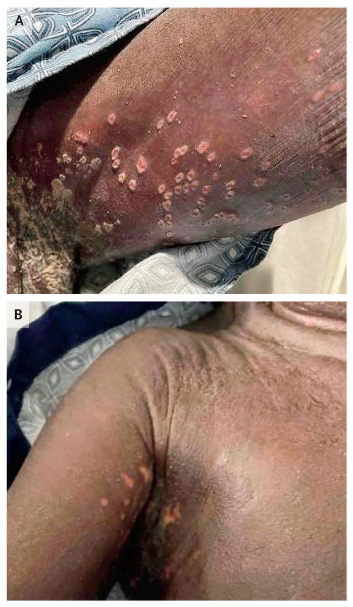 In the latest Case Record of the MGH, a 73-year-old woman was transferred to the hospital because of rash, leukocytosis, and eosinophilia. CT revealed a mass in the lung and diffuse lymphadenopathy. A diagnosis was made. Read the full case: nej.md/3QM4fzD