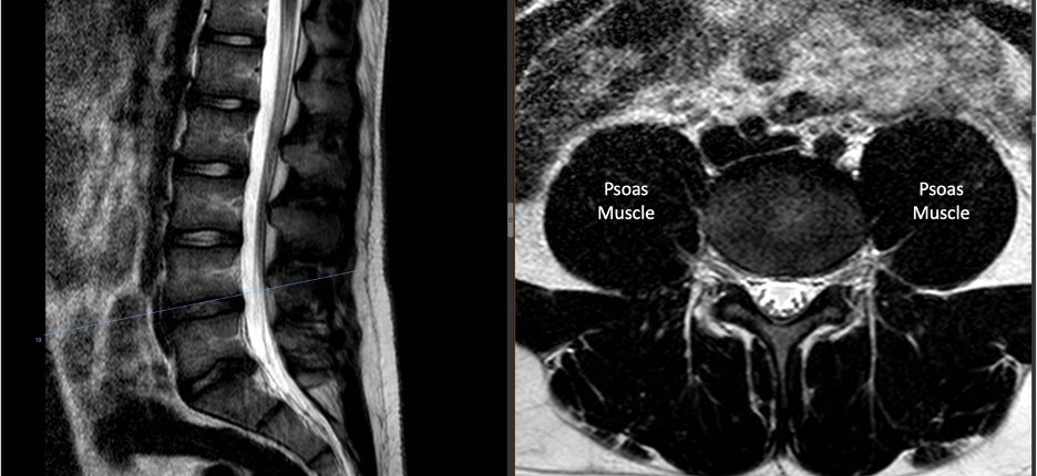 THE PSOAS INDEX, also known as the psoas muscle area or psoas muscle cross-sectional area, is a measurement used to assess muscle mass and function, particularly in the context of sarcopenia and frailty. It specifically focuses on the psoas muscle, which is a major muscle located