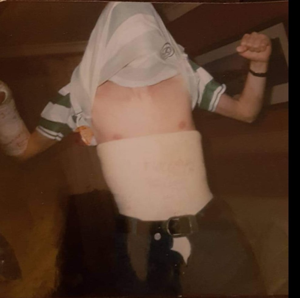 Just found this picture of myself in early 2000. I broke my back & arm in a car crash on Christmas day 1999.
I was in a body  cast for 5 months & had 2 pins in my arm. That body cast tho was an experience. Got out of hospital hogmanay afternoon for the millennium party....
