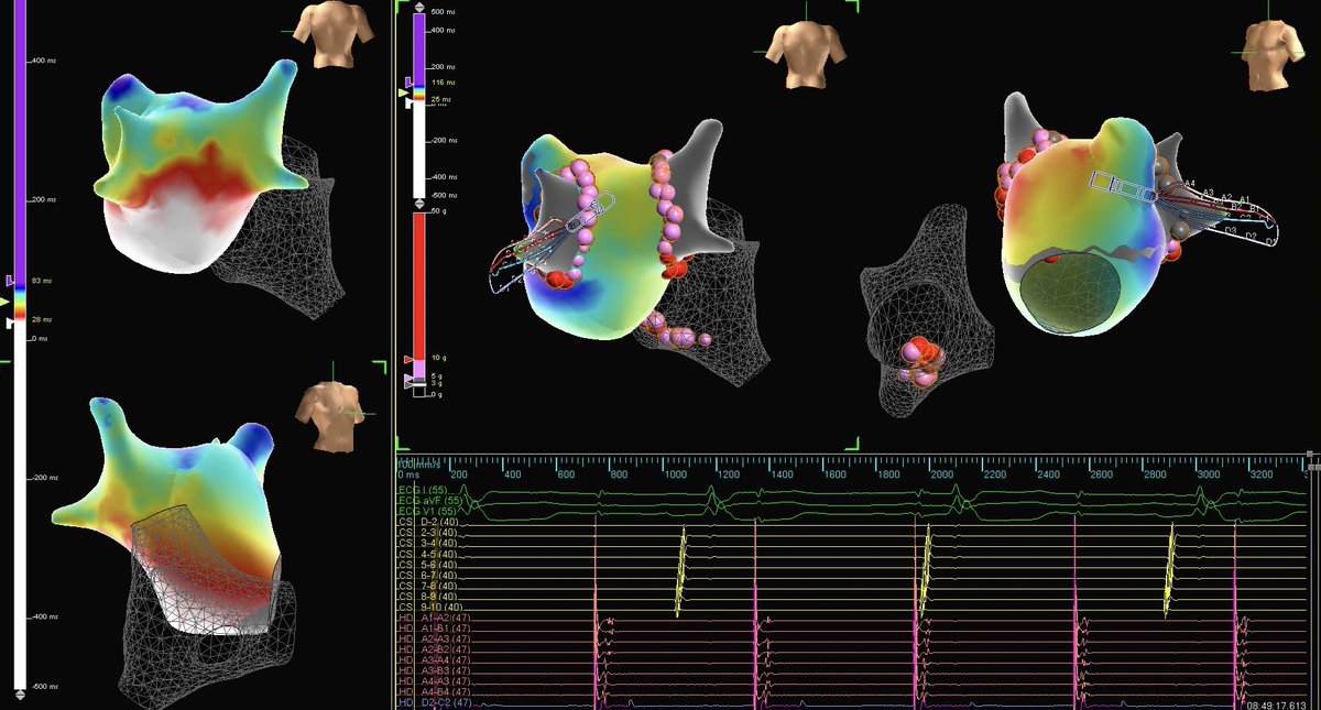 Still one of my favorite ways to confirm bidirectional block of the pulmonary veins! 

#PMA 

x.com/ep_emilys/stat…