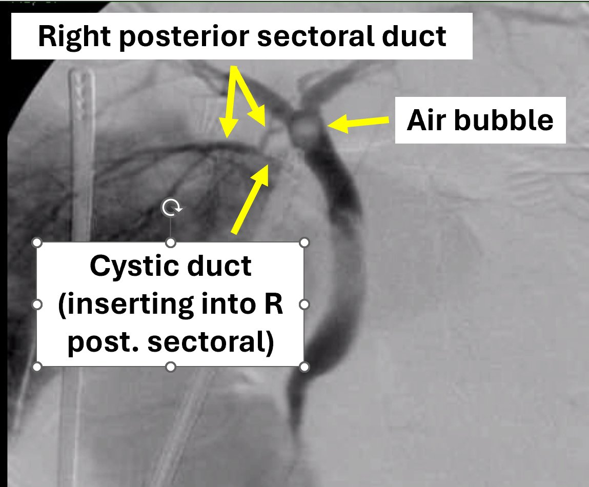 Lot of interesting ideas, but @jcdelo took it w his frame-by-frame analysis!! Cystic duct is very short + inserts directly into R posterior sectoral duct. Contrast goes into liver preferentially (creating the 'blush', not a vascular fistula). It's an air bubble CBD, not a stone..
