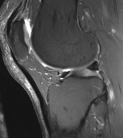 #CaseOfTheWeek‼️🥳‼️

☢️🩻☠️Case#19☠️🩻☢️

#IncidentalFinding

📲➡️➡️#Diagnosis❔❓❔

#FOAMRad #RadEd #MedEd #OrthoEd #OrthoTwitter @ssr_rwg @UWRadRes