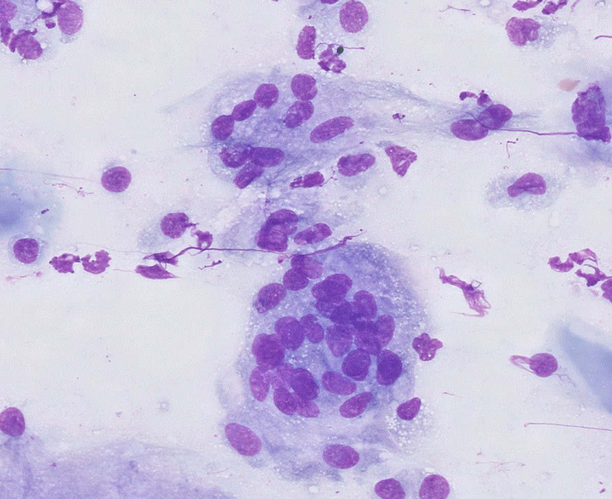 Art of veterinary cytology...
Granulomatous inflammation/ multinucleated macrophages