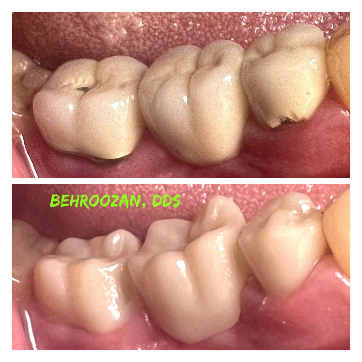 We digitally scan all our dentistry for utmost accuracy.   We replaced the 3 back teeth with a more natural,
metal-free option.  #yosipbehroozandds
#digitaldentistry #dentist #santamonica