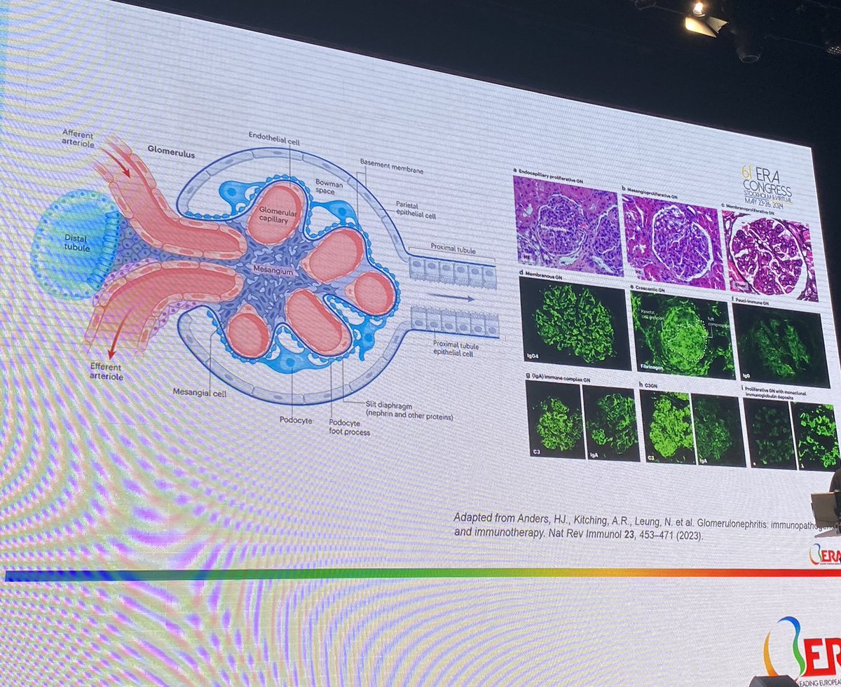 The primary function of the glomerulus is to filter the blood. Traditional classification of glomerular disease has relied on the appearance of patterns of injury. That classification gives no sense of pathological mechanisms of disease or treatment. #ERA2024