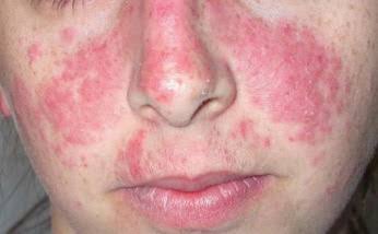 Malar Rash (Butterfly Rash) 🦋: Erythematous rash over the cheeks and bridge of the nose, sparing the...