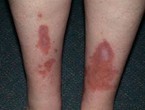 37/ Necrobiosis Lipoidica 💉: Yellowish-brown patches with atrophic centers, often on the shins, asso...