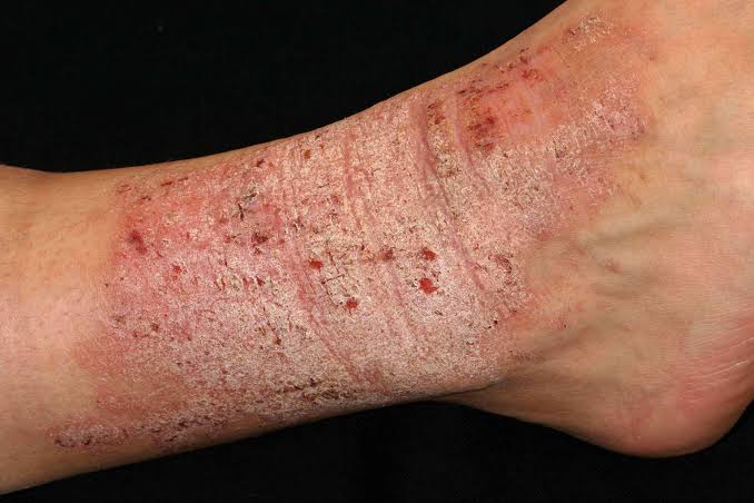 38/ Lichen Simplex Chronicus 🔄: Thickened, scaly plaques from chronic scratching or rubbing. https:/...