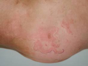 41/ Erythema Marginatum 🌸: Pink rings on the trunk and inner surfaces of the limbs, often associated...