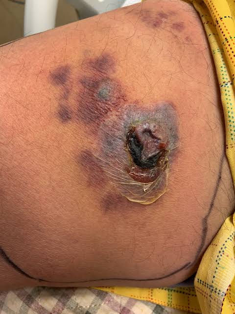 42/ Ecthyma Gangrenosum ⚠️: Necrotic ulcers with a surrounding erythematous halo, often caused by Ps...