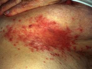 43/ Candidiasis 🍄: Red, itchy rash with satellite lesions, commonly in warm, moist areas. https://t....