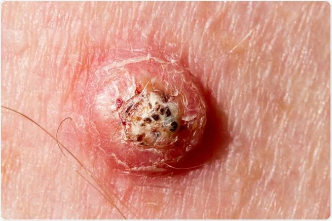 44/ Keratoacanthoma 🕳️: Rapidly growing, dome-shaped nodule with a central keratin-filled crater. ht...