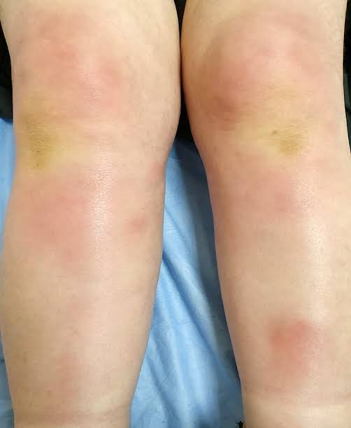 🧵 Must-Know Dermatology Images for USMLE Step 2 CK 
(Part 2)

21/ Erythema Nodosum 🚨: Painful, red n...