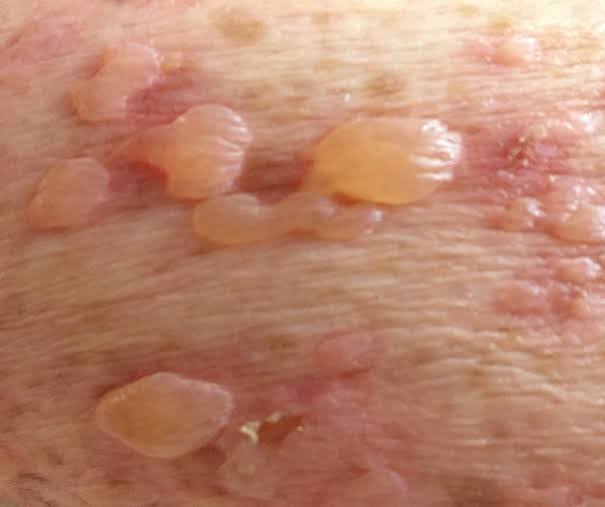 23/ Bullous Pemphigoid 🔹: Tense, subepidermal blisters, often in elderly patients, with a negative N...