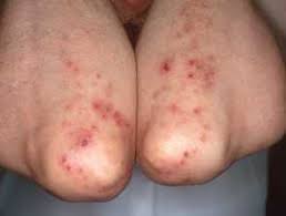 25/ Dermatitis Herpetiformis 🌟: Intensely pruritic papules and vesicles, often on elbows, knees, and buttocks, associated with celiac disease.