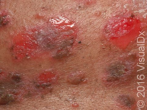 24/ Pemphigus Vulgaris ❗: Flaccid blisters and erosions, often involving mucous membranes, with a po...