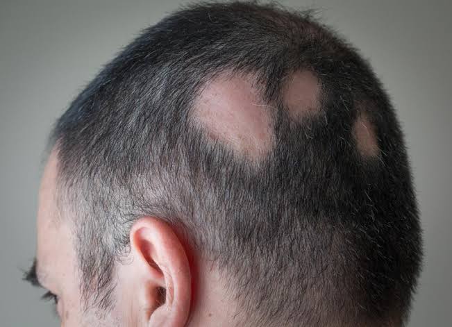 26/ Alopecia Areata 🌀: Sudden, well-demarcated patches of hair loss, often with exclamation point ha...