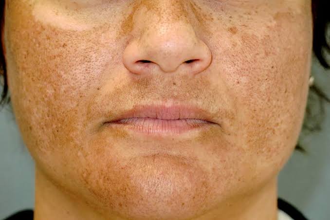 28/ Melasma 🌞: Symmetric hyperpigmented patches, often on the face, associated with pregnancy or hor...