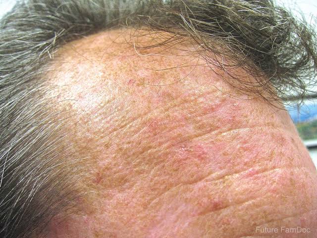 29/ Actinic Keratosis ⚡: Rough, scaly patches on sun-exposed skin, precancerous for squamous cell ca...