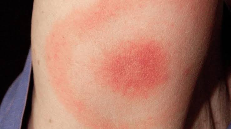 30/ Erythema Chronicum Migrans 🎯: The hallmark of Lyme disease; expanding red rash with central clea...