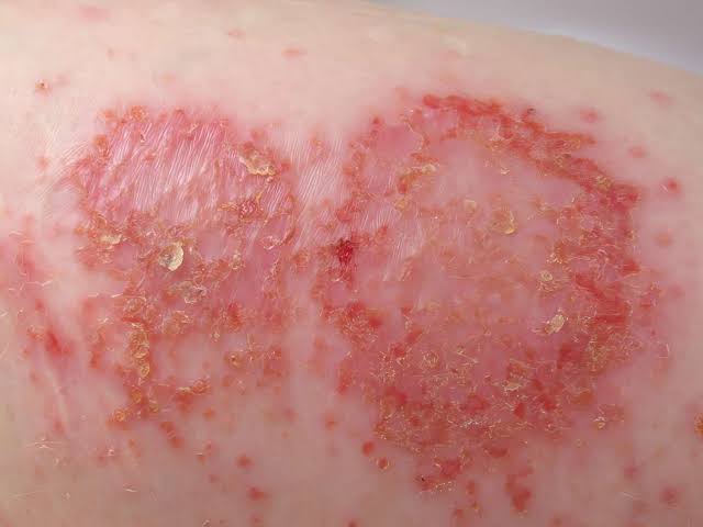 32/ Nummular Dermatitis 🔵: Coin-shaped, itchy, red plaques, often on the legs.