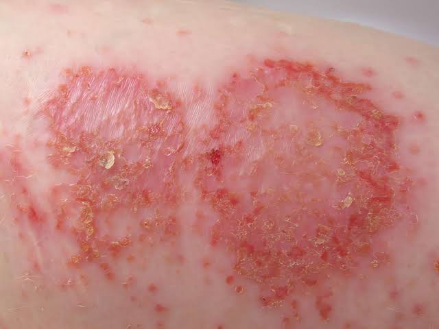 32/ Nummular Dermatitis 🔵: Coin-shaped, itchy, red plaques, often on the legs. https://t.co/DK7nCVDb...