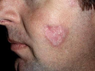 31/ Lupus (Chronic Cutaneous Lupus) 🦋: Discoid lesions, scaly, erythematous plaques that can lead to...