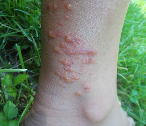33/ Contact Dermatitis 🖐️: Erythematous and vesicular lesions at the site of contact with allergens...