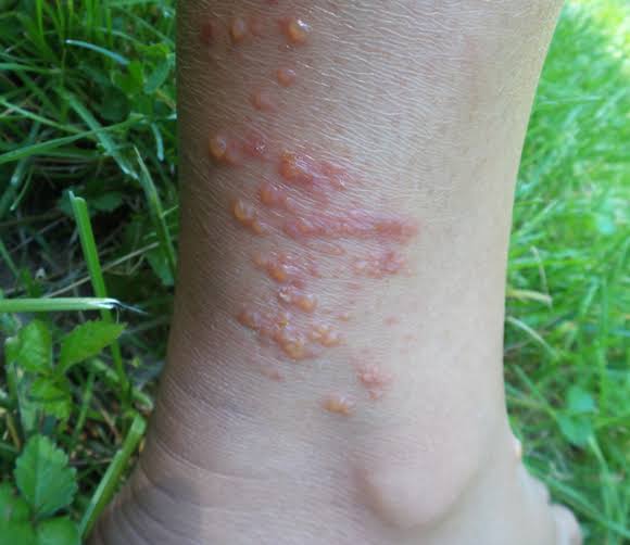 33/ Contact Dermatitis 🖐️: Erythematous and vesicular lesions at the site of contact with allergens or irritants.