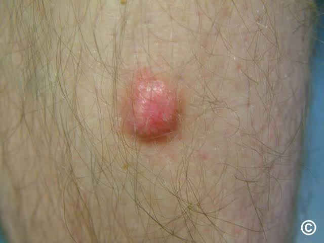 34/ Dermatofibroma 📏: Firm, hyperpigmented nodules, often with a central dimple when pinched (dimple...